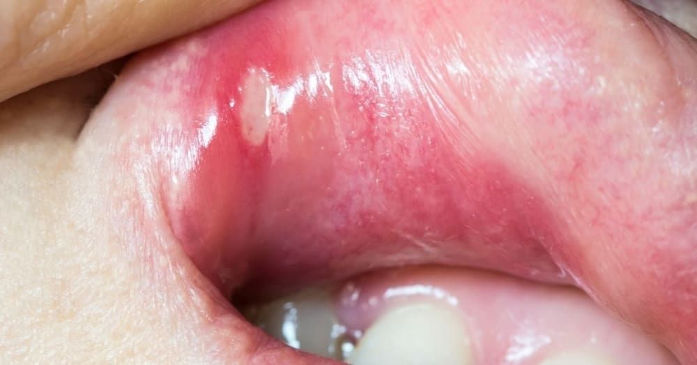 mouth-ulcer-home-remedies-15-effective-remedies-that-work